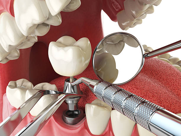 Best Emergency Denture Repair in Britton, SD